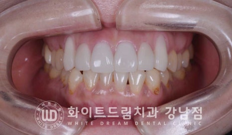 치경부착색 치료 / 라미네이트 vs 올세라믹 치아 삭제량 비교 (Feat. 라미네이트 후 치아미백 가능한가요?) 관련 이미지 2