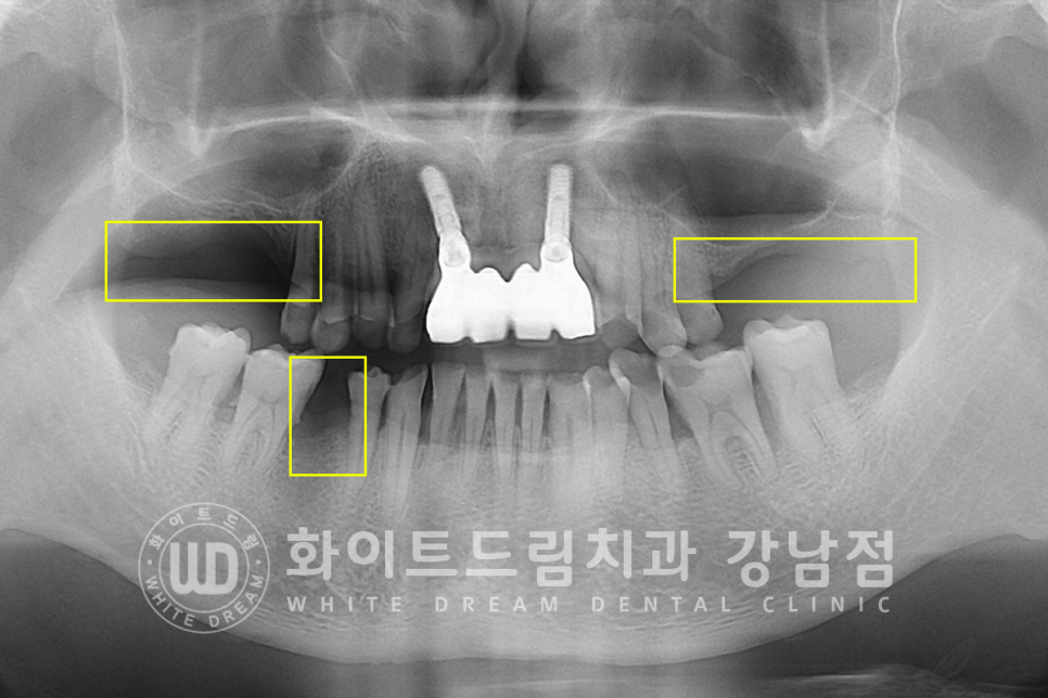 강남역 임플란트치과 / "어금니가 없고 이갈이가 심해요" 강남역 화이트드림치과 관련 이미지 2