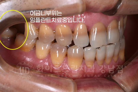 강남역 인근 치과 / 테트라사이클린(tetracycline) 치아 변색 / 라미네이트로 개선! 관련 이미지 4