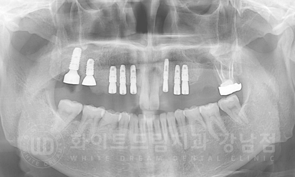강남역 치과브릿지 "브릿지가 흔들려요" 흔들리는 브릿지 치료는? 관련 이미지 7
