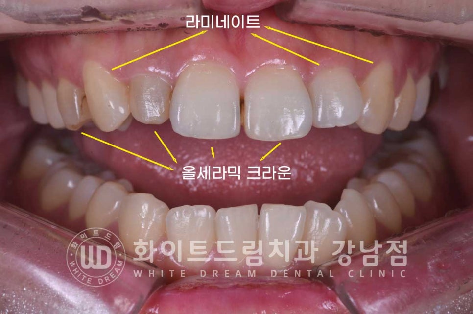 신경치료 후 크라운을 씌워야 하는 이유 & 신경치료 후 변색 치료 Case 리뷰 관련 이미지 7