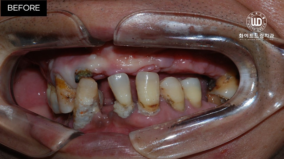 전체임플란트 식립 및 임플란트뼈이식 후기 관련 이미지 6
