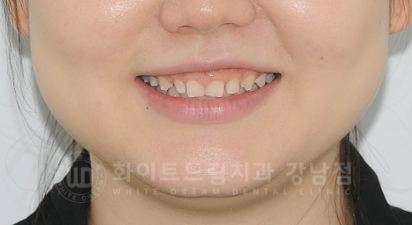 강남역 라미네이트 "치아가 작고 벌어졌어요" 거미스마일 + 벌어진 치아 개선 관련 이미지 17