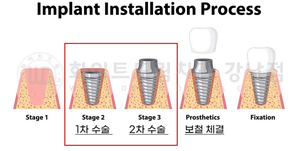 임플란트 1차 수술, 2차 수술이란 무엇일까? (+ 상악 전체 임플란트 치료 기간) 관련 이미지 2