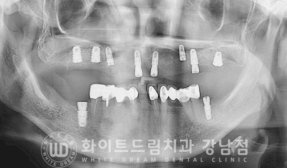 상악 풀케이스임플란트 사례 "부산에서 강남까지 왔어요" 관련 이미지 10