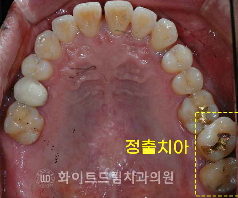 강남역치과 임플란트 "발치 후 바로 임플란트가 가능한 경우 vs 기다려야 하는 경우" 관련 이미지 5