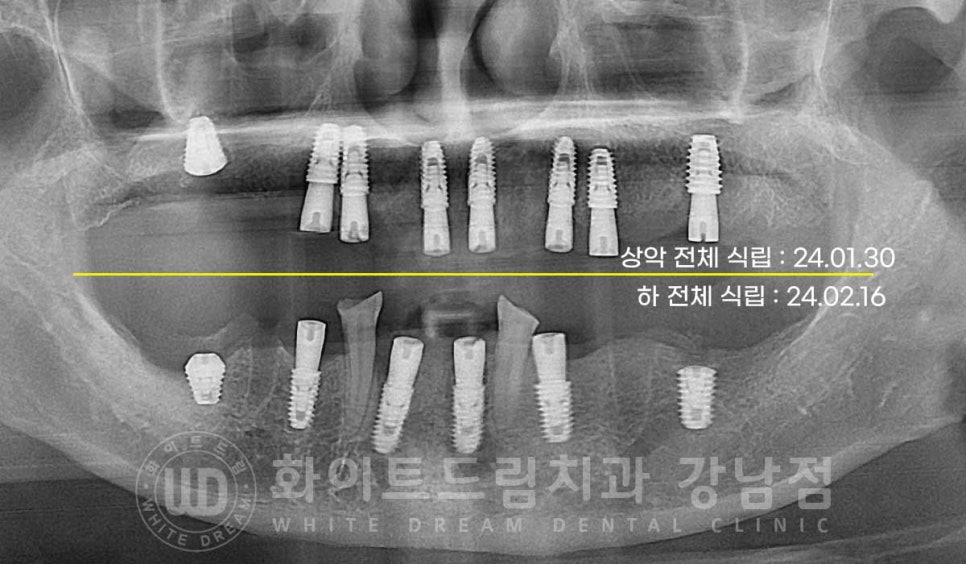 치주염 전체임플란트 치료 사례 / 치아를 흔들리게 만드는 치주염이란? 관련 이미지 12