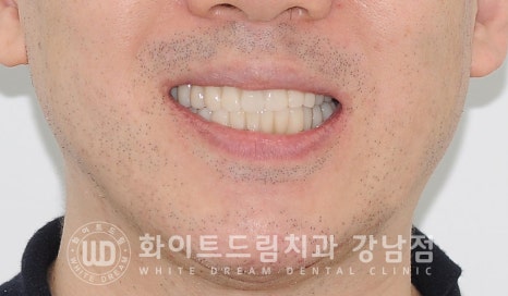 40대 전체임플란트 / 디지털스캔바디를 이용한 전체 임플란트 치료 사례 (Feat. 치주염) 관련 이미지 2