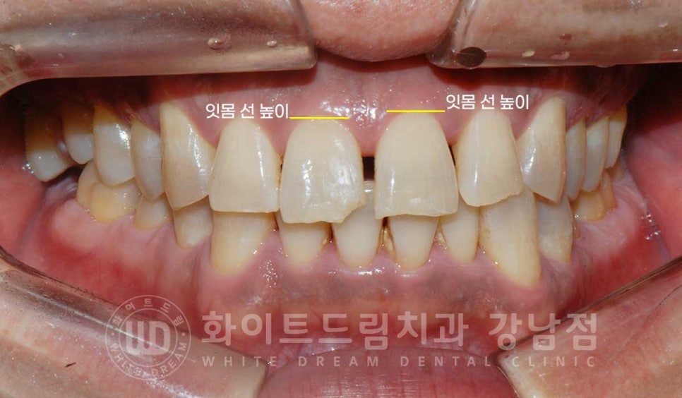 벌어지고 깨진 앞니, 웨딩 앞니 라미네이트 치료 사례 "남자도 자연스럽게 라미네이트 가능한가요?" 관련 이미지 7