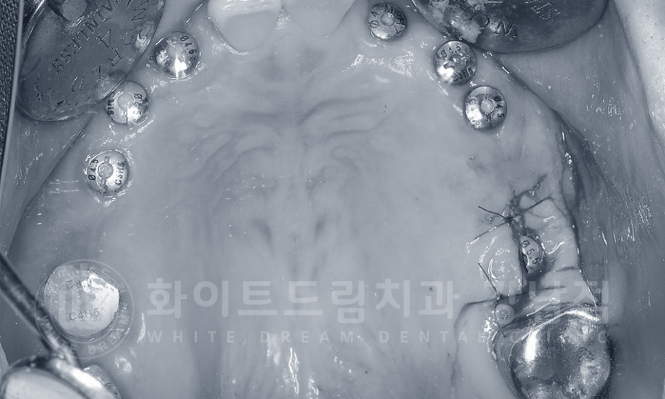 강남역 치과브릿지 "브릿지가 흔들려요" 흔들리는 브릿지 치료는? 관련 이미지 9