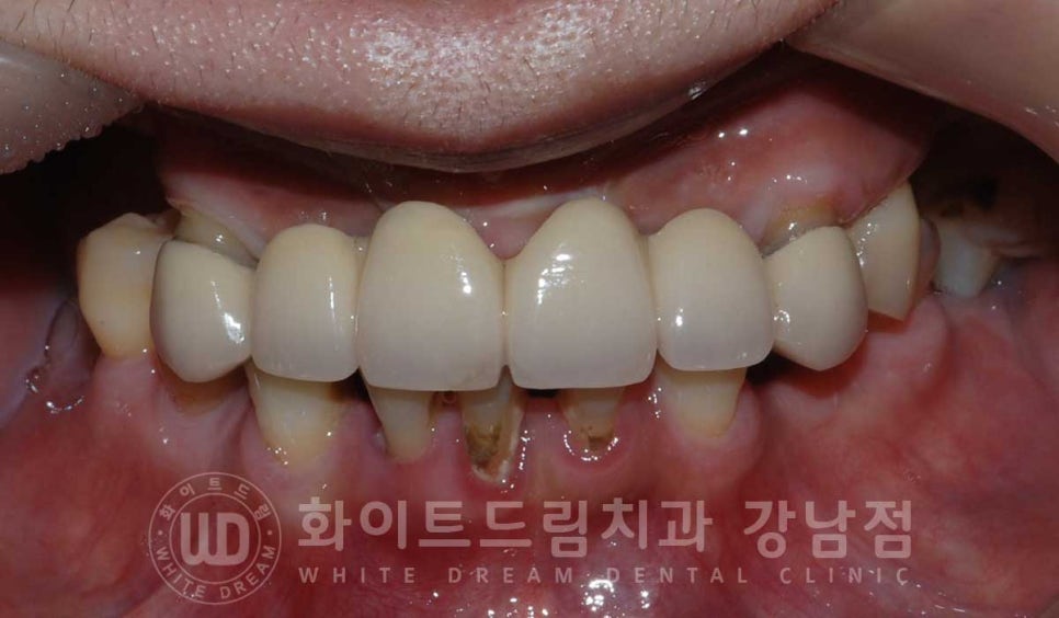 치주염 전체임플란트 치료 사례 / 치아를 흔들리게 만드는 치주염이란? 관련 이미지 7
