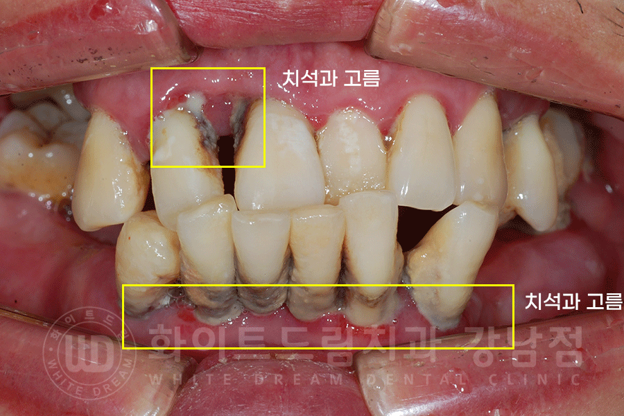 강남역 전체임플란트 치과 "치아가 심하게 흔들려요." 심한 치주염 임플란트 치료 관련 이미지 2