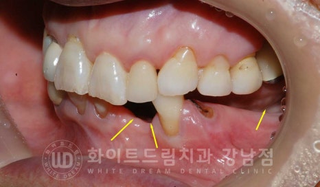 잇몸뼈가 없다는 게 무슨 말일까? "틀니를 오래 사용해서 잇몸뼈가 없대요" 임플란트 잘하는 강남치과 관련 이미지 3