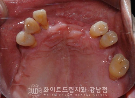 치주염 전체임플란트, 염증으로 인한 상악동 천공 & 신경관 가까이 녹은 잇몸뼈. 임플란트 식립 가능할까? 관련 이미지 16