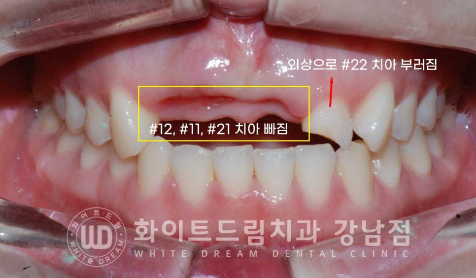 앞니 빠짐 임플란트 / 사고로 인한 앞니 탈구. 앞니 임플란트 치료는? 관련 이미지 4