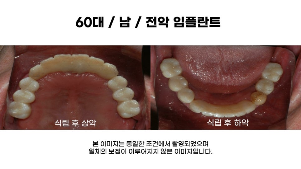 60대 전악임플란트후기 및 치료기간 관련 이미지 11