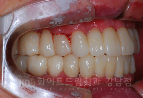 강남역 전체임플란트 치과 "치아가 심하게 흔들려요." 심한 치주염 임플란트 치료 관련 이미지 24