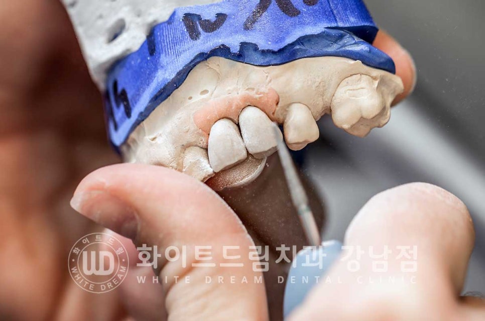 신경치료 후 크라운을 씌워야 하는 이유 & 신경치료 후 변색 치료 Case 리뷰 관련 이미지 11