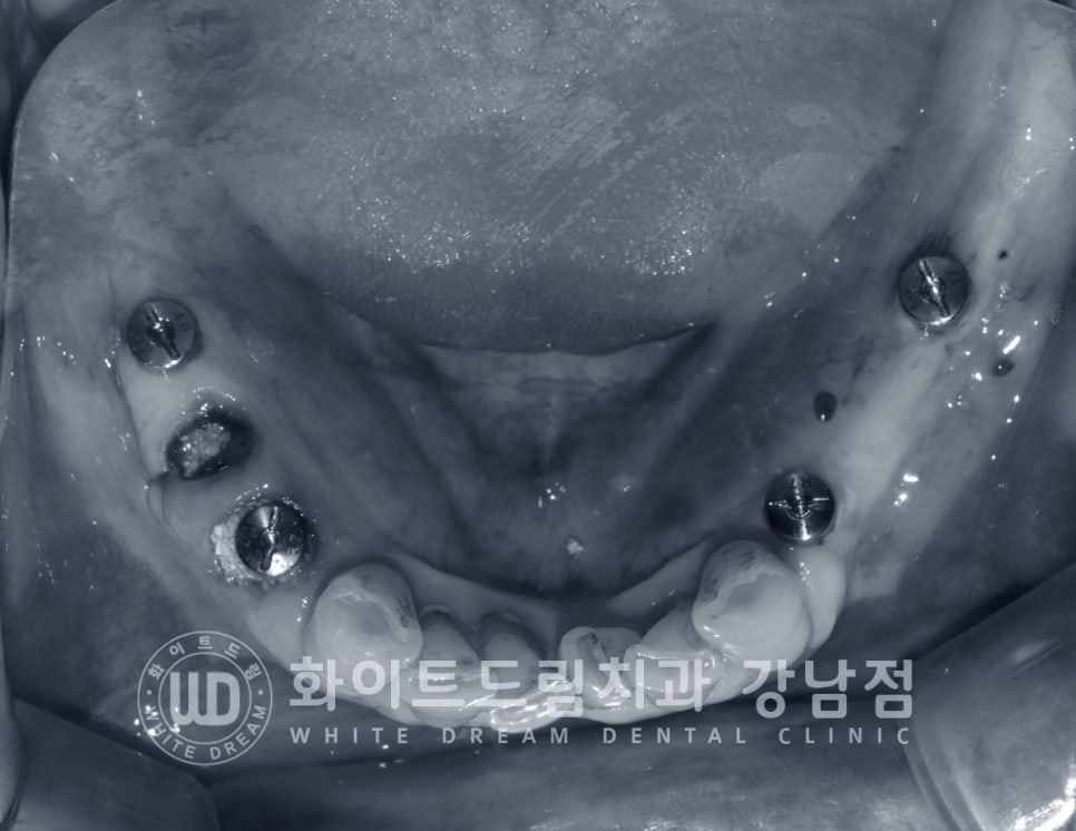 상악 풀케이스임플란트 사례 / "지인 추천으로 인천에서 왔어요." 관련 이미지 11