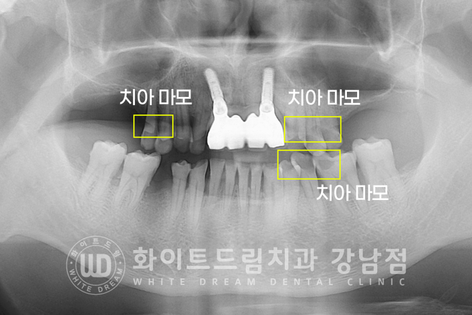 강남역 임플란트치과 / "어금니가 없고 이갈이가 심해요" 강남역 화이트드림치과 관련 이미지 9