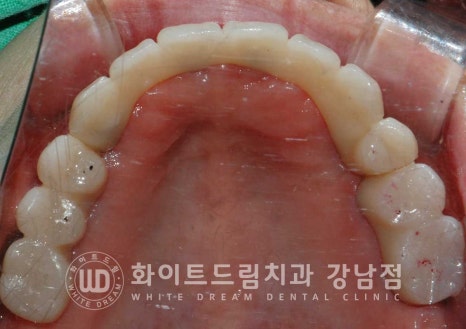 상악 풀케이스임플란트 사례 "부산에서 강남까지 왔어요" 관련 이미지 19