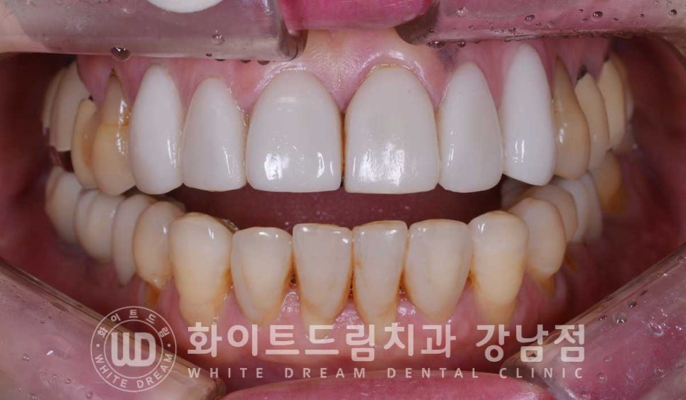 앞니라미네이트 교체 "5년 전에 한 라미네이트가 뻗쳐 보여요" 예쁘게 치료할 수 있나요? 관련 이미지 5