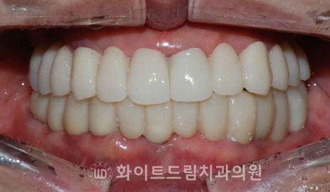 서울전체임플란트 / "경상도에서 왔어요." 치주염으로 인한 앞니 돌출 치료 (+서울전체임플란트 내원 횟수는?) 관련 이미지 14