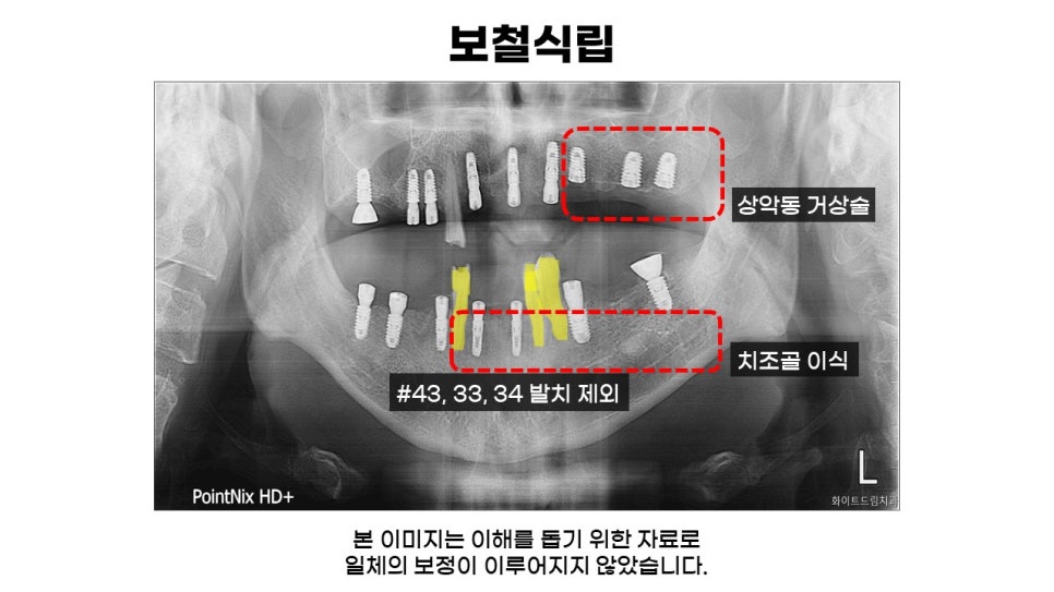 고연령 전체임플란트 과정 및 임플란트 치료기간, 전체임플란트식립후기 관련 이미지 4