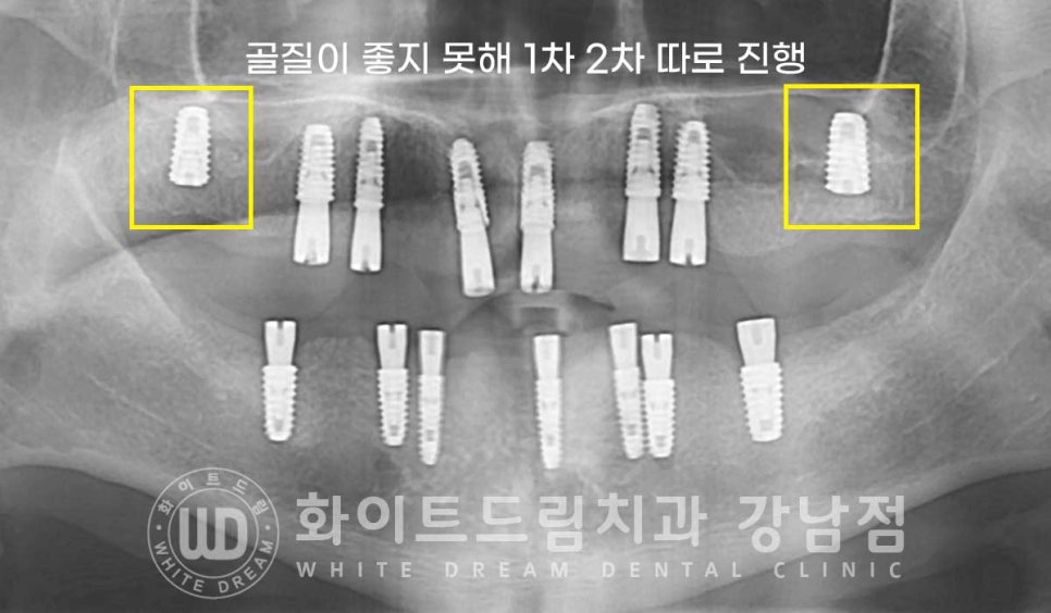 전체 임플란트 치료 기간과 수술 후 나타나는 변화는? 관련 이미지 10