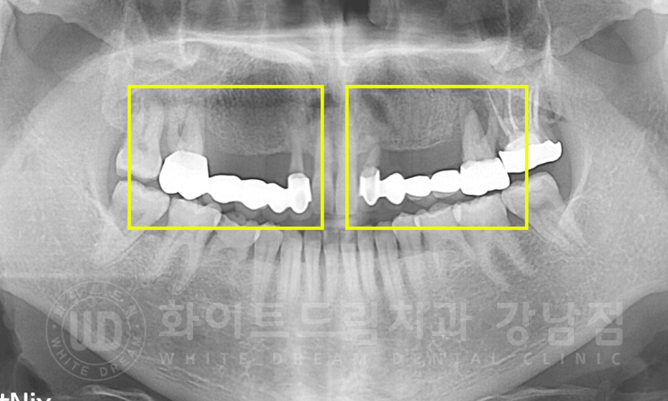 강남역 치과브릿지 "브릿지가 흔들려요" 흔들리는 브릿지 치료는? 관련 이미지 3