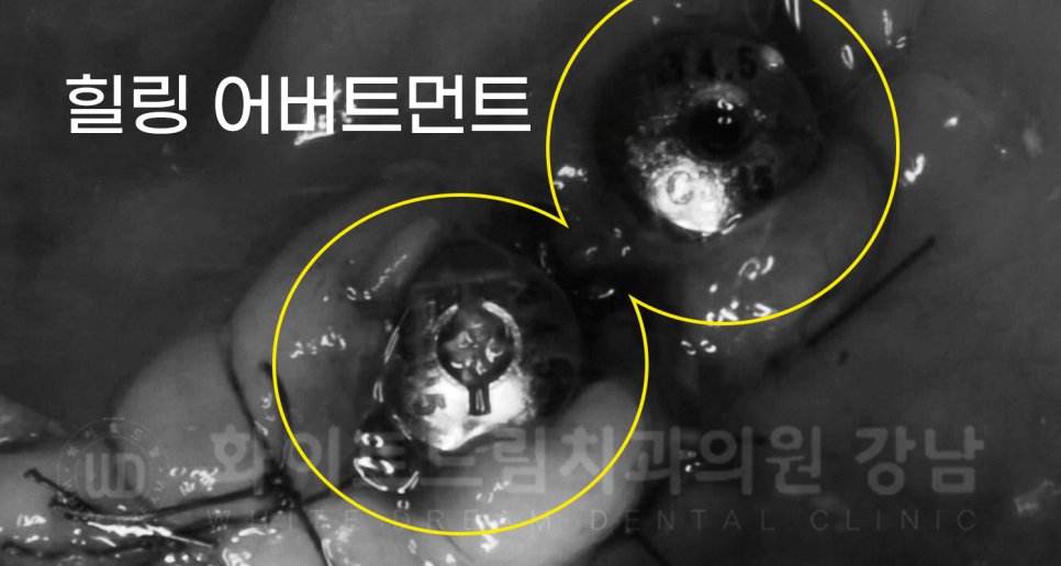 강남역 임플란트 치과 "틀니가 안 맞아서 불편해요" 틀니 → 전체 임플란트로! 관련 이미지 15