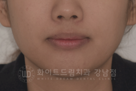 신논현역 라미네이트 / 과개교합 치아교정 + 왜소치 라미네이트 진행 case 관련 이미지 8