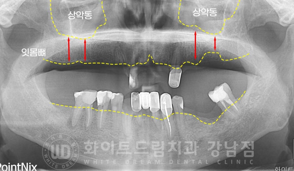 전체 임플란트 치료 기간과 내원 횟수는? "치과에 자주 가기 어려워요." 관련 이미지 10