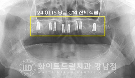 전체 임플란트 치료 기간과 수술 후 나타나는 변화는? 관련 이미지 8