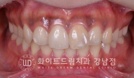 신경치료 후 변색된치아, 라미네이트로 변색과 모양까지 개선! / 강남역화이트드림치과 관련 이미지 10