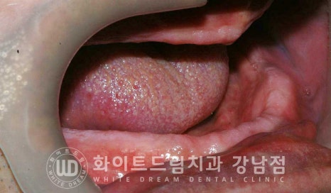 전체 임플란트 치료 기간과 수술 후 나타나는 변화는? 관련 이미지 7