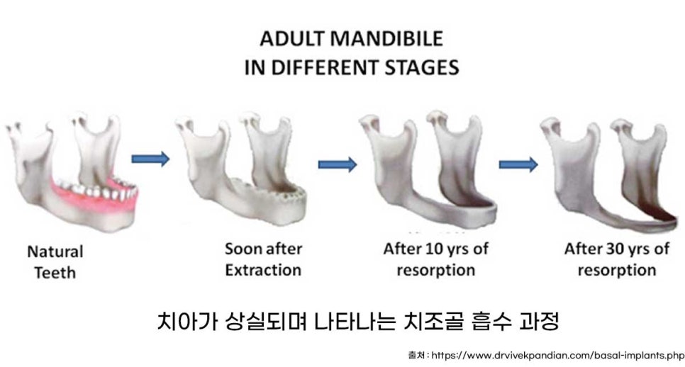 잇몸뼈가 없다는 게 무슨 말일까? "틀니를 오래 사용해서 잇몸뼈가 없대요" 임플란트 잘하는 강남치과 관련 이미지 2