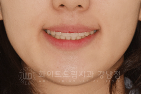 강남 덧니 비발치교정 / 임플란트와 치아교정 동시 진행 case 리뷰. 관련 이미지 3