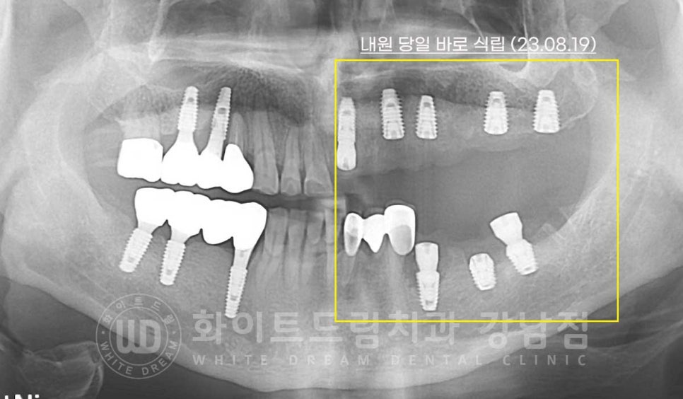 임플란트 재수술의 주원인, "임플란트 주위염과 임플란트 찢어짐!" 관련 이미지 12