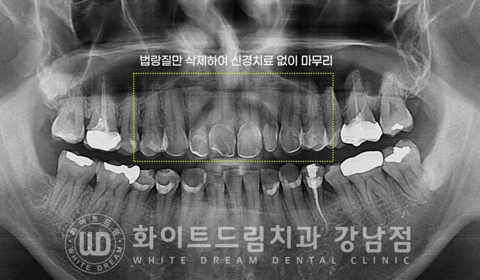 앞니 레진변색 "너무 지저분해 보여요." 라미네이트로 깔끔하게 교체한 치료 사례 관련 이미지 14