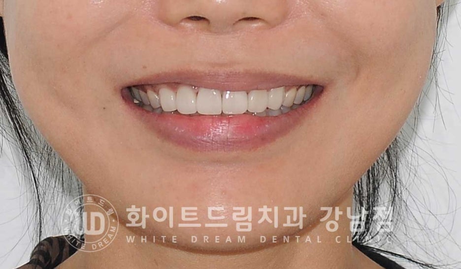 벌어진 앞니 라미네이트 / 50대 시니어 라미네이트 치료 사례 관련 이미지 12