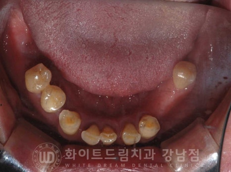 치주염 전체임플란트 치료 사례 / 치아를 흔들리게 만드는 치주염이란? 관련 이미지 6