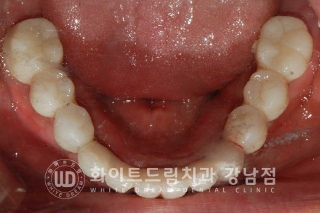 강남역 전악임플란트치과 / 치주 질환이 치아와 임플란트에 끼치는 영향! 관련 이미지 15