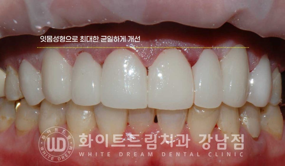 앞니 레진변색 "너무 지저분해 보여요." 라미네이트로 깔끔하게 교체한 치료 사례 관련 이미지 13