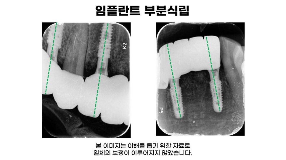 고연령 전체임플란트 과정 및 임플란트 치료기간, 전체임플란트식립후기 관련 이미지 6