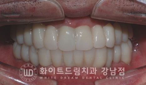 40대 전체임플란트 / 디지털스캔바디를 이용한 전체 임플란트 치료 사례 (Feat. 치주염) 관련 이미지 10