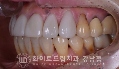 앞니라미네이트 교체 "5년 전에 한 라미네이트가 뻗쳐 보여요" 예쁘게 치료할 수 있나요? 관련 이미지 3