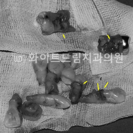 강남역전체임플란트 / 발치 후 즉시 식립, 무조건 누구나 3개월로 끝낼 수 있는 것일까? 강남역화이트드림치과 관련 이미지 11