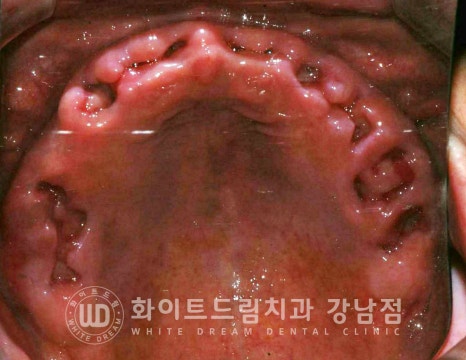 상악 풀케이스임플란트 사례 / "지인 추천으로 인천에서 왔어요." 관련 이미지 4