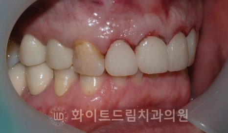 신논현역 당일 라미네이트, "길이가 다른 깨진 앞니" 당일 앞니 라미네이트 치료 과정은? 관련 이미지 15